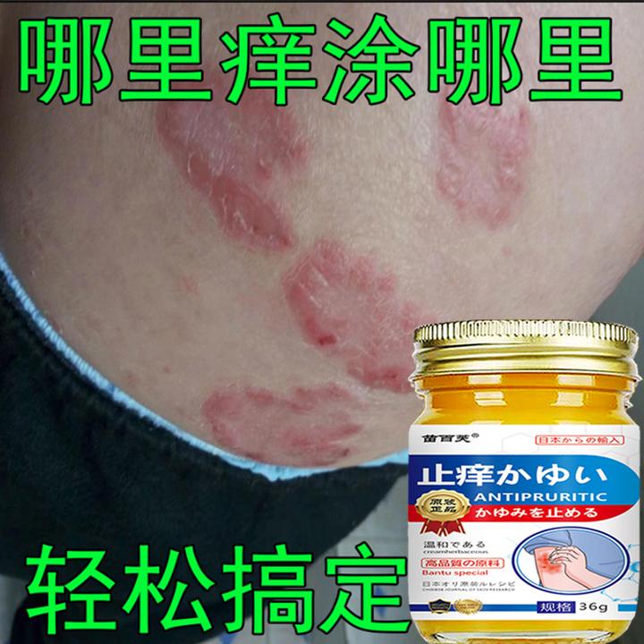 【主播亲测】顽固牛皮头藓银屑膏手足股止痒大腿内侧痒全身可用