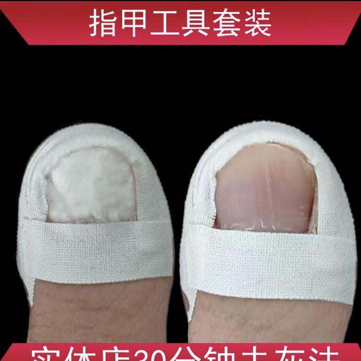 趾指甲实体店包甲工具套餐增厚空甲变色