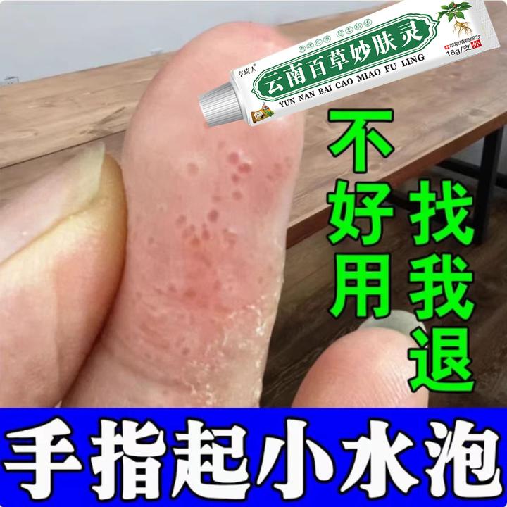 手上起小水泡外用涂抹手指手缝红痒渗液脱皮止痒清凉护理草本乳膏