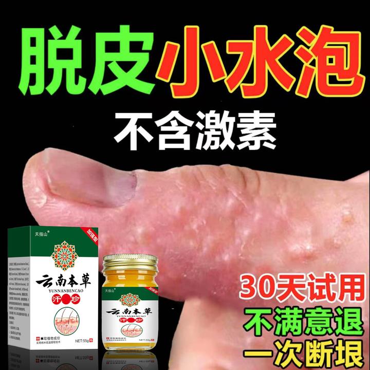 汗泡诊克星手上起小水泡止痒膏脱皮手指缝痒干裂专用草本乳膏