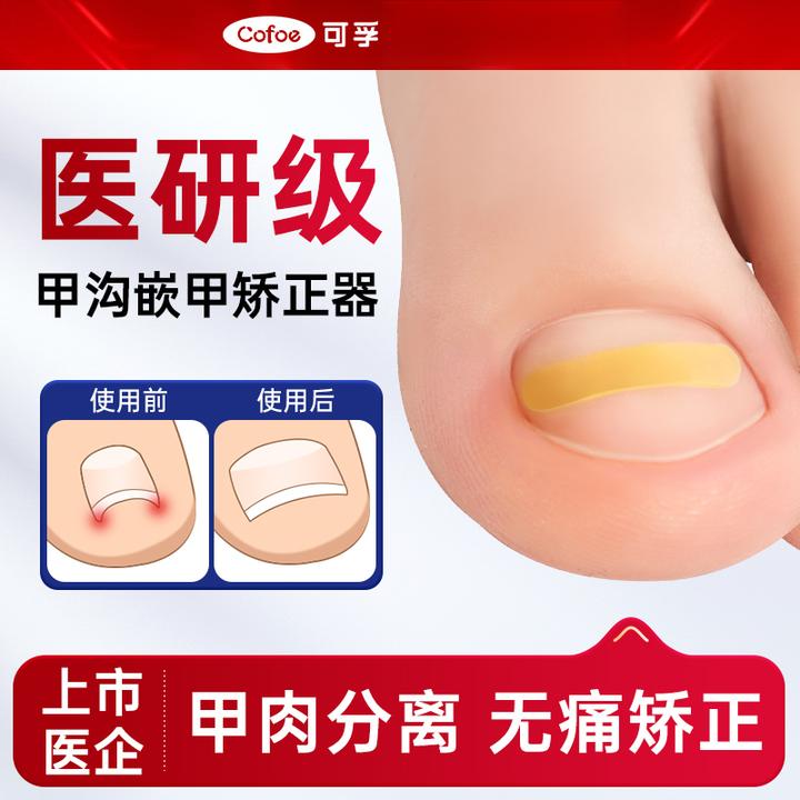 可孚嵌甲修甲矫正器专用指甲贴片脚趾甲重度正甲贴脚趾内嵌甲沟炎