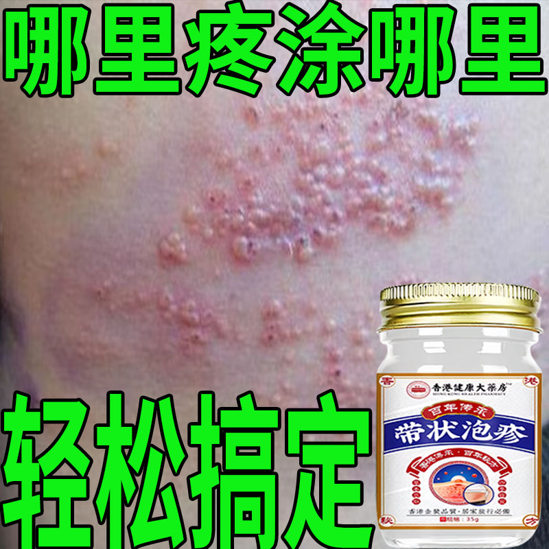 带状泡疹后遗神经痛蛇盘疮膏蛇盘清宝带状疱疹后遗症神经痛特效药