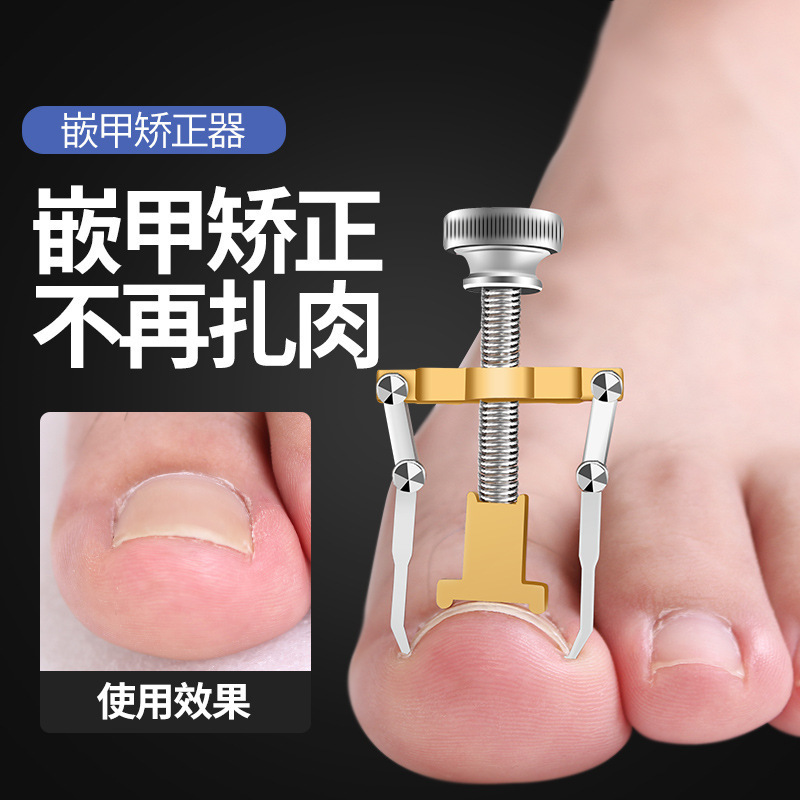 甲沟炎矫正神器指甲矫正器纠正嵌甲脚趾甲往肉里长怎么办隔离垫片