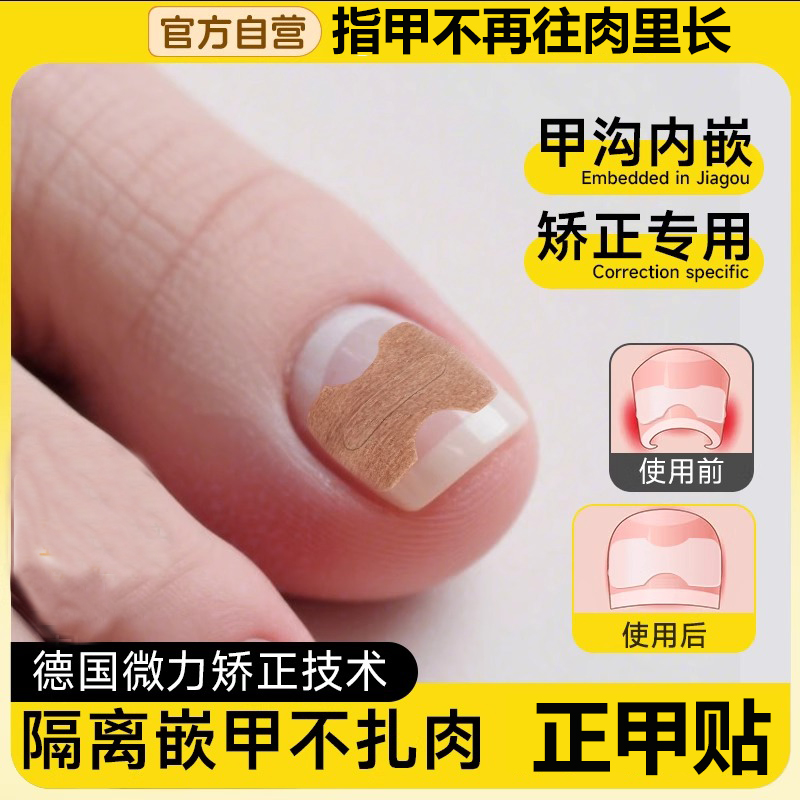 正甲贴甲沟炎矫正神器嵌甲纠正器指甲扎肉脚趾甲往肉里长专用工具