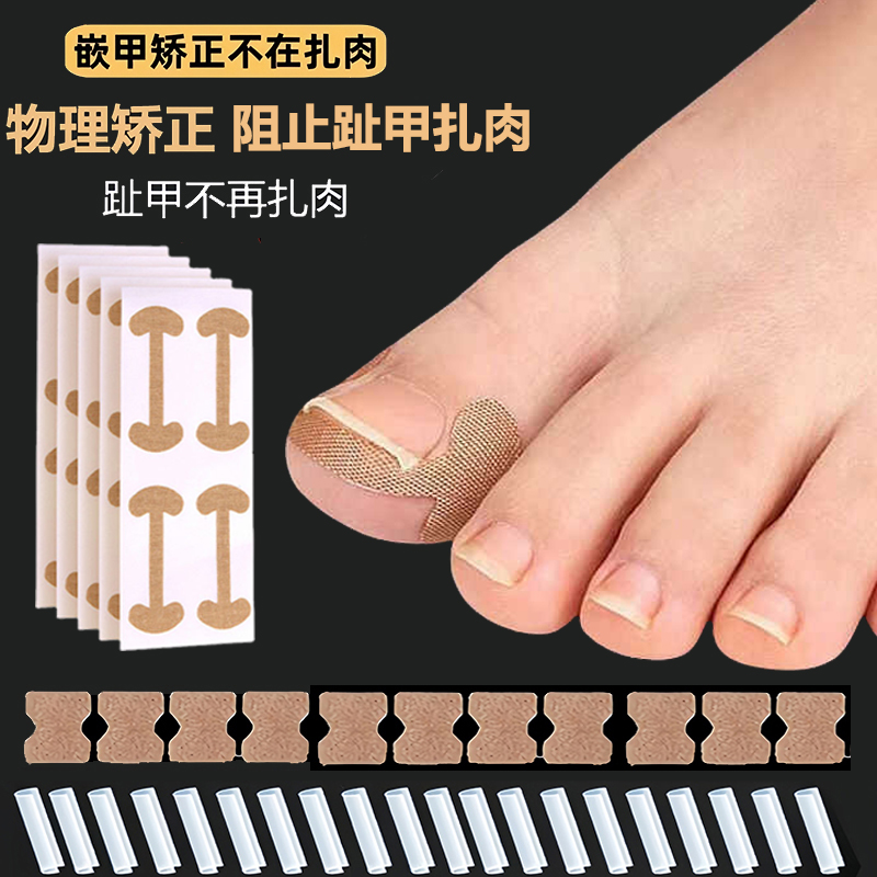 甲沟矫正神器嵌甲矫正贴片指甲往肉里长专用隔离纠正脚趾甲填充垫