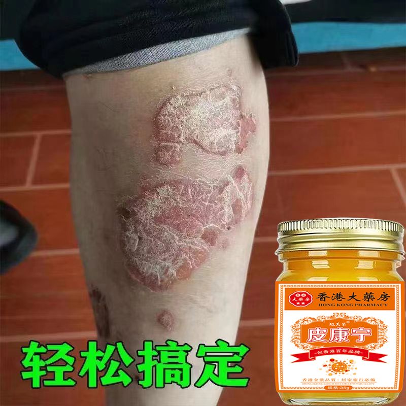 【香港皮康宁】牛皮肤银屑膏头藓顽固手足止痒大腿内侧痒全身可用