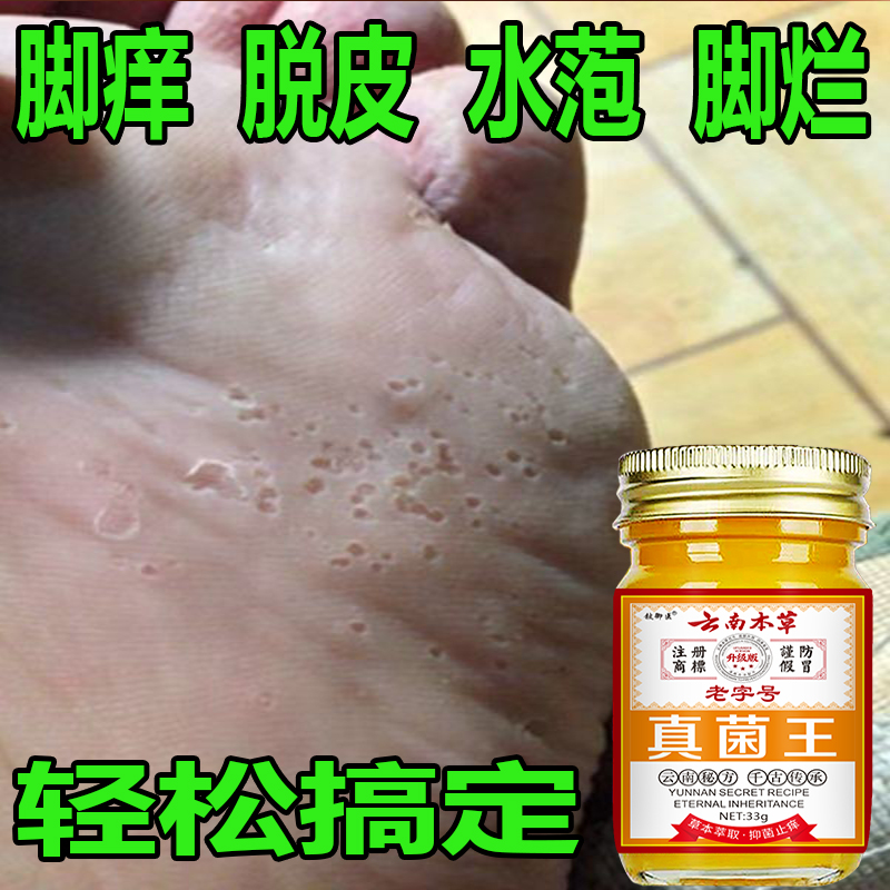正品真菌王脚痒脚臭脚缝痒脱皮脚底痒脚止痒膏肩颈贴脚部问题适用