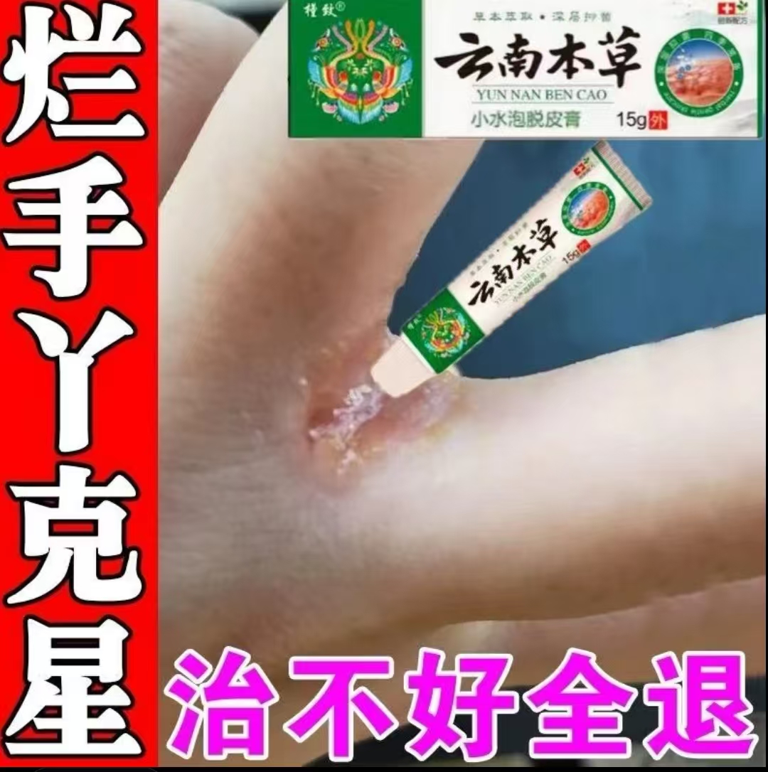 手指缝溃烂经常碰水烂手丫糜烂瘙痒干裂疼痛真菌感染手鲜专用药膏