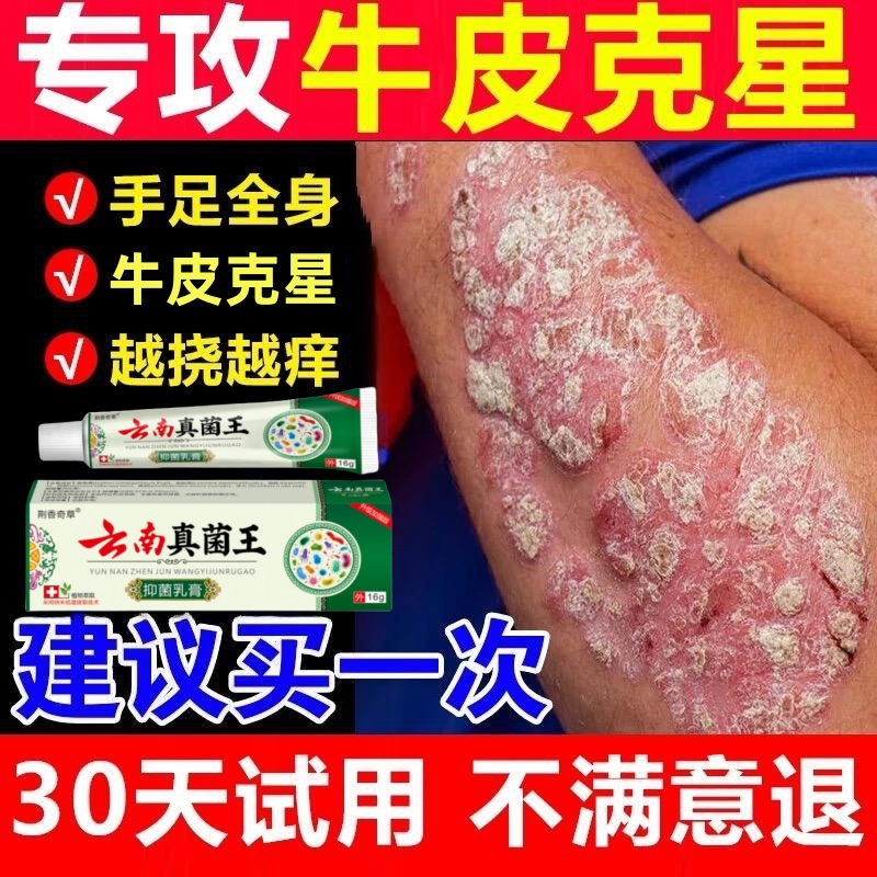 【云南真菌王】牛皮廯银屑痒鳞屑湿痒膏藓手足痒藓抑菌草本止痒乳膏
