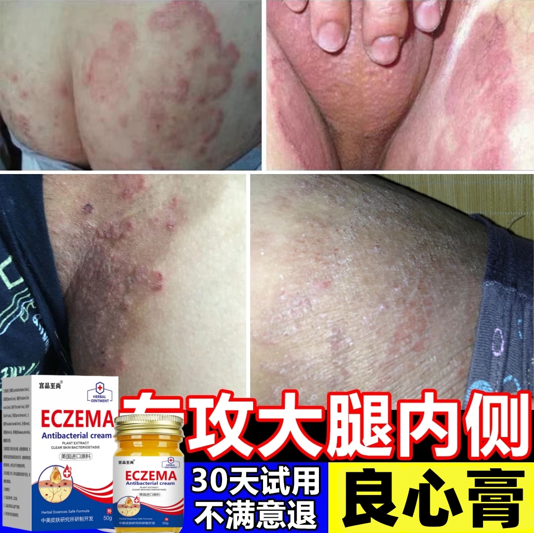 【一款很牛的湿痒膏】皮肤瘙痒干痒大腿内侧痒草本外用快速止痒乳膏