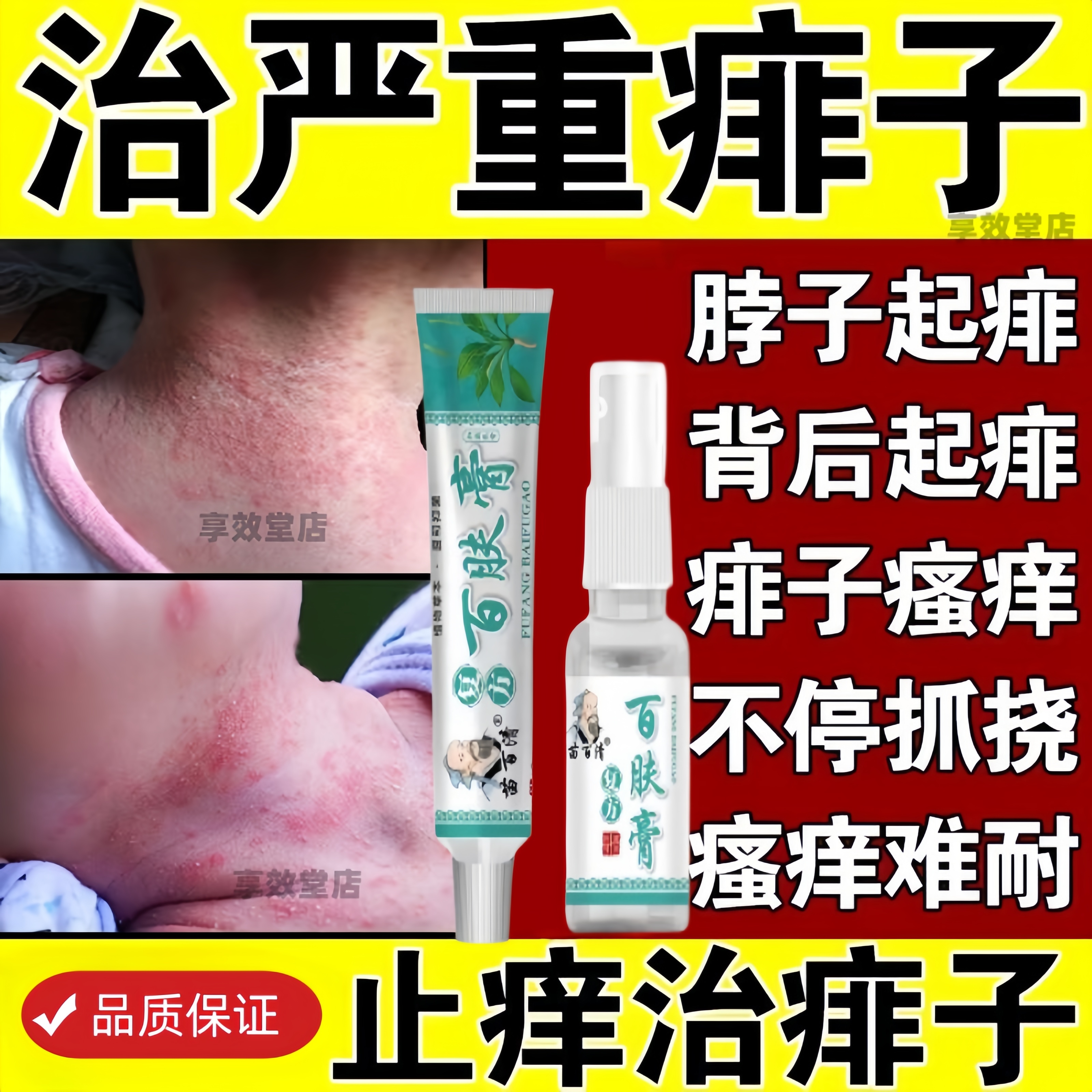 膏去痱子粉专用淹脖子去痱止痒热疹秋痱成人儿童宝宝乳膏热痱子