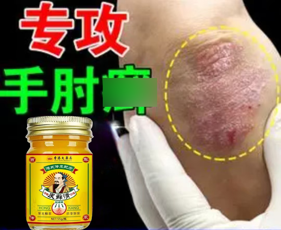 全身红痒廯皮肤止痒顽固手足体股红点止痒乳膏