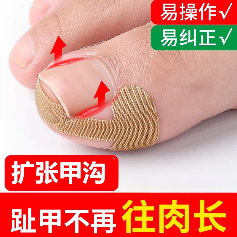 正甲贴甲沟炎矫正神器嵌甲矫正器指甲扎肉脚趾甲长肉了专用纠正贴