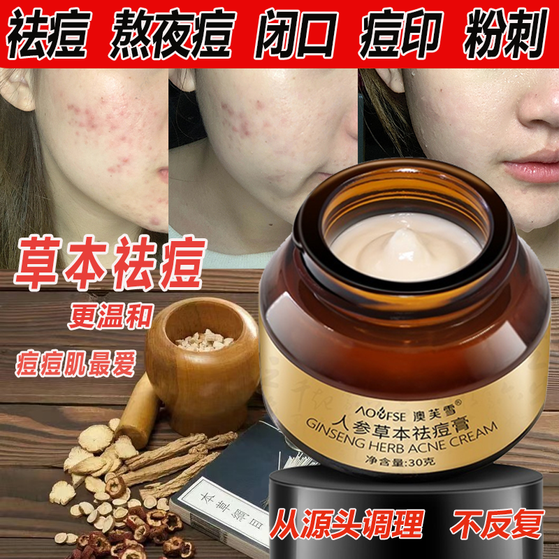 祛痘膏淡化痘印痘坑痘疤青春痘学生男女去黑头去闭口粉刺祛痘面霜